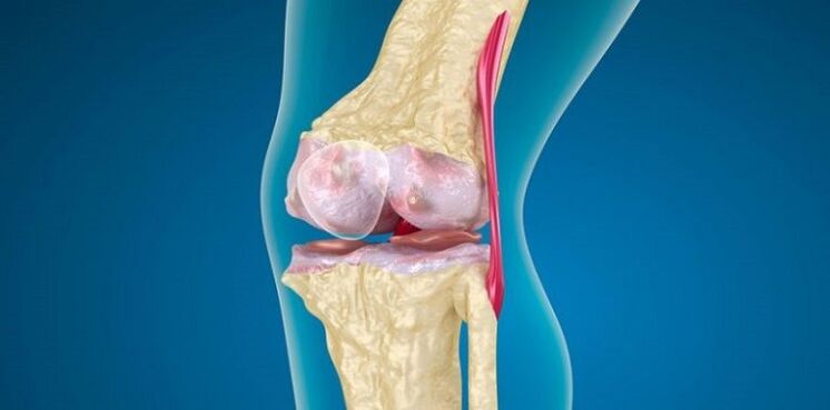 Endommager l'articulation du genou pour l'arthrose